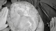 Sjældent tilfælde: 14-årig pige fundet med en tumor, der vejede over 4 kg, og som indeholdt tænder, hår og knogler.