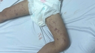 Brote de meningitis meningocócica: Dak Lak realiza un rastreo urgente de contactos.