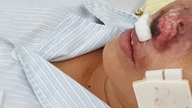 Horečka způsobená sesuvem půdy se snadno špatně diagnostikuje a může se vyvinout do těžkého stádia.