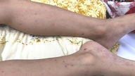Ho Chi Minh City: 7-årig dreng med meningokoksygdom reddet.