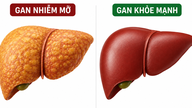 Tanıdık bir vitamin, yağlı karaciğer hastalığı için 'hayat kurtarıcı' olabilir.