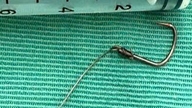 În timp ce mânca fructe de mare fără să fie atent, un bărbat s-a înfipt adânc în esofag cu un cârlig.
