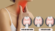 Những bệnh tuyến giáp ngày càng phổ biến trong cộng đồng
