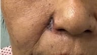 Kes yang jarang berlaku: Daripada tahi lalat kecil, kanser merebak dan memusnahkan sayap hidung.