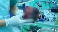 Ignoring mild stomach pain, a man nearly lost his life to a tumor the size of a cantaloupe.