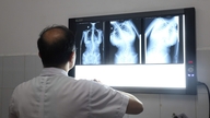 Recunoașterea precoce a semnelor de scolioză la copii