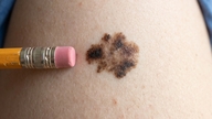 Experts warn that signs of cancer are easily overlooked.