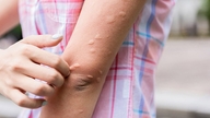 Mề đay dễ bùng phát khi nắng nóng: 3 cách làm giảm ngứa, dịu da