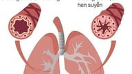 Milloin astmaatikon tulisi hakeutua välittömästi lääkärin hoitoon?