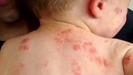 Sommerimpetigo: Tidlig opdagelse for at undgå komplikationer