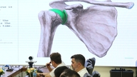 Osteoartrita umărului la tineri din cauza leziunilor sportive.