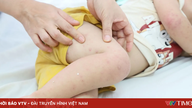 Tilfælde af denguefeber er faldende, men tilfælde af hånd-, fod- og mundsyge fortsætter med at stige i Ho Chi Minh City.