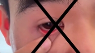 Der Trick, „Parasiten“ aus dem Auge zu ziehen.