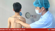 Le dépistage précoce de la scoliose est crucial pour éviter les complications.