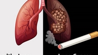 Rokok menyebabkan 90% kasus kanker paru-paru.