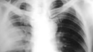 Risiko einer invasiven Pneumokokkenerkrankung