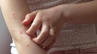 Dấu hiệu ngứa do ký sinh trùng