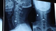 Un homme de 43 ans a souffert de douleurs cervicales et d'engourdissements dans les mains pendant deux ans en raison d'une affection médicale que beaucoup de Vietnamiens négligent facilement.