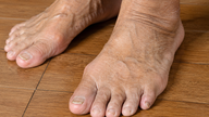 Diabetes: ¿Por qué las pequeñas heridas en los pies son propensas a complicarse?