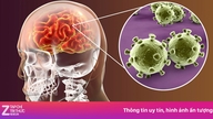 जापानी एन्सेफलाइटिस - बच्चों में होने वाली एक प्रमुख और खतरनाक संक्रामक बीमारी।