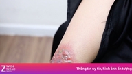 Eine Frau in Ho-Chi-Minh-Stadt musste ins Krankenhaus eingeliefert werden, nachdem sie über 85 Millionen VND für die Entfernung eines Tattoos ausgegeben hatte.