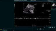 Opération réussie pour une femme enceinte portant des « fœtus jumeaux » extrêmement rares à Nghe An.