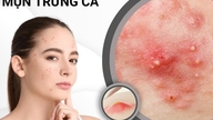 Em que idade a acne costuma durar?