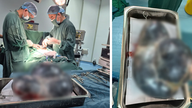 Quang Tri: Berhasil melakukan pengangkatan tumor ovarium dengan berat sekitar 5 kg.
