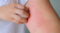 Tratamentul și prevenirea erupțiilor cutanate cu mâncărime cauzate de mușcăturile de purici.