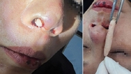 Após a rinoplastia, a mulher teve que remover toda a cartilagem devido a um acidente.