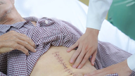 Un hombre en estado crítico fue salvado de un aneurisma de la aorta abdominal.