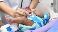 Rettung des Lebens eines extrem frühgeborenen Babys mit einem Gewicht von nur 800 g.