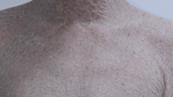 ພະຍາດ ichthyosis ແຕ່ກຳເນີດແມ່ນສະພາບທີ່ຕ້ອງການການຄຸ້ມຄອງຕະຫຼອດຊີວິດ.