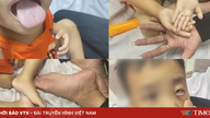 Children suffer from severe anemia due to consuming only milk and prolonged anorexia.