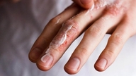 Orvosi hírek frissítése július 5-én: Sok gyermek került kórházba veleszületett ichthyosis miatt.