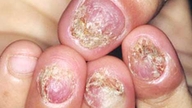 爪真菌症（手足の爪）の効果的な治療法。