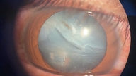 Um jovem foi atingido no olho por um pedaço de arame, sofrendo uma laceração no globo ocular.