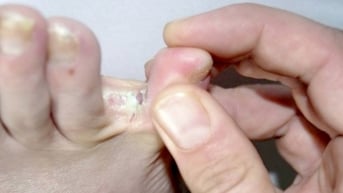 Cần lưu ý gì khi mắc nấm chân mùa lũ?