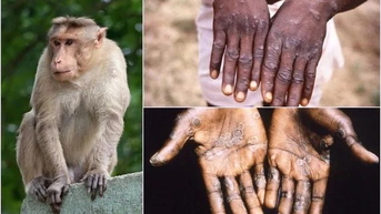 Giám sát nghiêm ngặt để phát hiện ca nghi mắc đậu mùa khỉ ngay từ cửa khẩu
