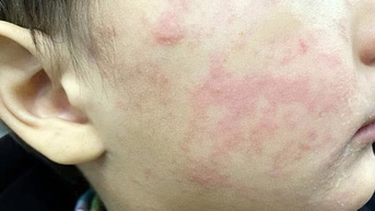 Nhận biết ban do sởi hay phát ban do vi rút