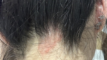 염색약으로 인한 피부 자극