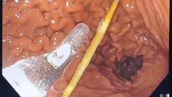 Suýt thủng dạ dày vì thói quen vừa ngậm tăm vừa uống nước