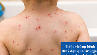 Triệu chứng bệnh thuỷ đậu qua từng giai đoạn như thế nào?