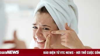 Những điều cần biết trước khi nặn mụn