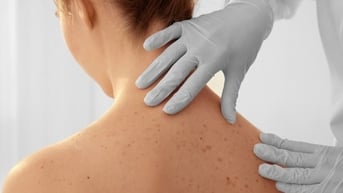 Chớ chủ quan với những bất thường trên da