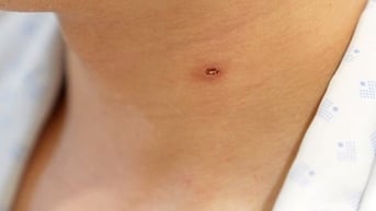 Người đàn ông bị suy thận cấp do ong vò vẽ đốt