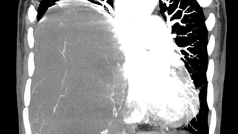 Từ chối điều trị, sau một năm khối u phát triển nặng 2kg đè xẹp phổi