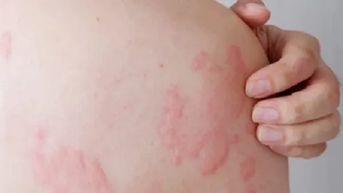 Nổi mề đay có phải là dấu hiệu ung thư gan?