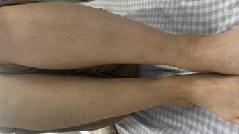 여성, 피임약 5년 복용 후 위험한 합병증 겪어