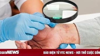 Tự ý điều trị ngứa, nam thanh niên bị nấm mọc toàn thân